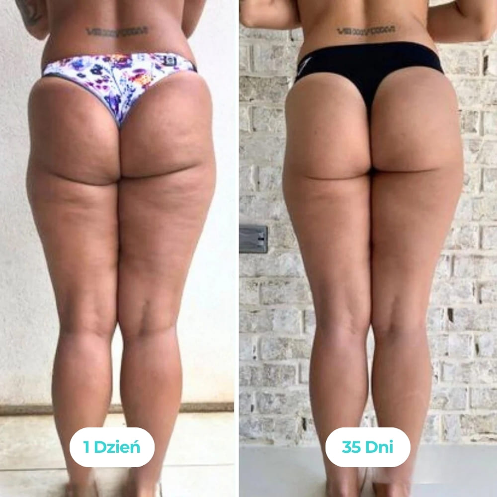 Vibraskin® - Poprawia wygląd skóry